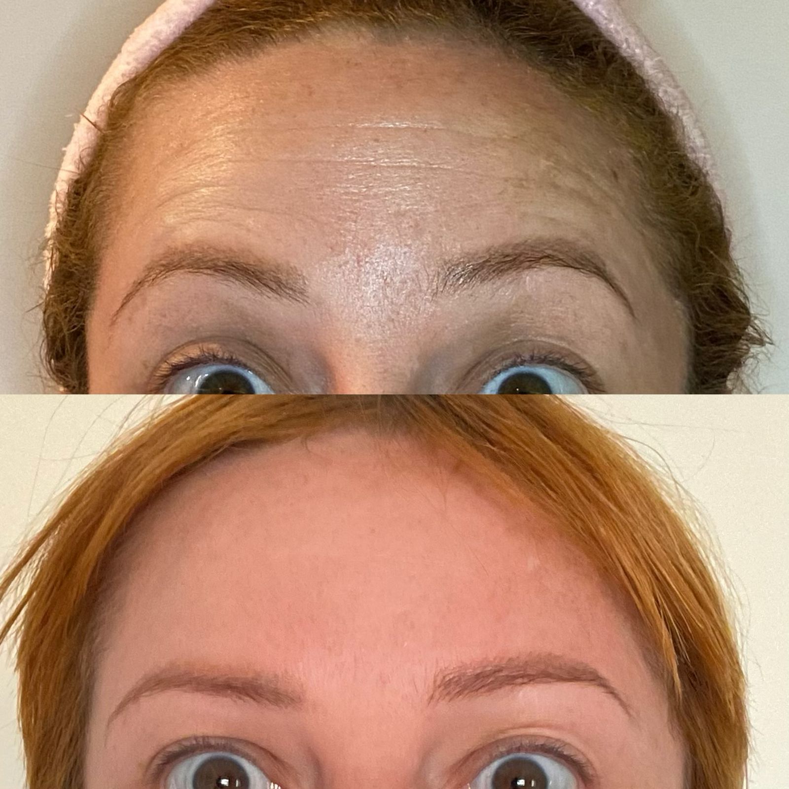 botox